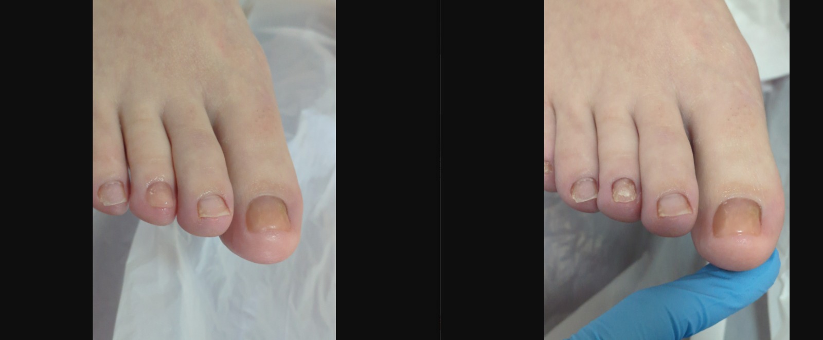 Nail Augmentation Nail reconstruction – The Beute Clinic